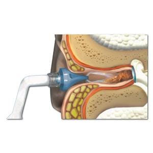 Otoclear oorspoeling - Otoclear set, 20 tips + fles + opvang bekken